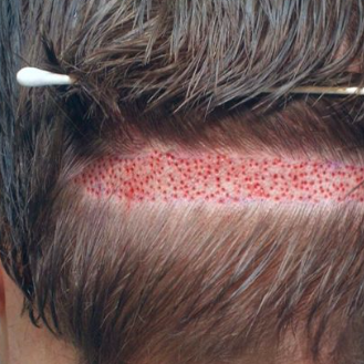 Hair   Transplant